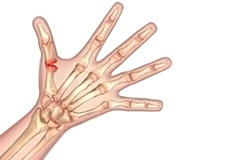 arthritis-of-hand