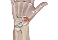 Triscaphoid Joint Arthritis