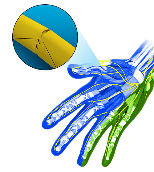 Peripheral Nerve Repair