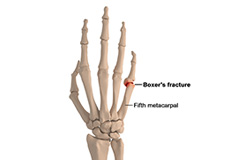 Boxer's Fracture