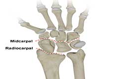 Carpal Instability