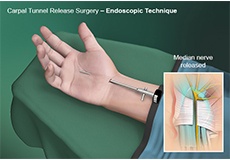 carpal-tunnel-release-surgery-endoscopic-technique
