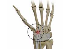 Distal Intersection Syndrome