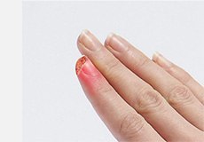 Fingertip Injuries