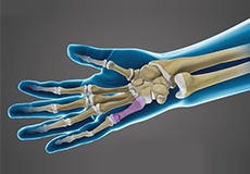 repair-of-fractures
