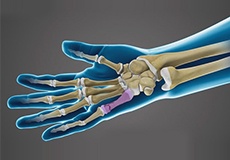 Fractures of the Hand and Fingers