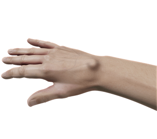 Ganglion Cyst