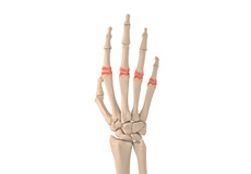 Metacarpophalangeal Joint Arthritis