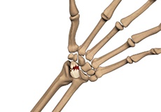 Scaphoid Fracture