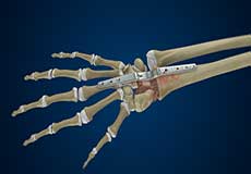 Surgery for Wrist Arthritis