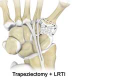 Trapeziectomy