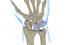 Triquetrolunate Instability