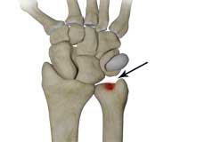 Ulnar Carpal Impaction