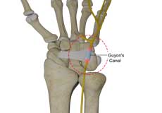 Ulnar Nerve Compression in Guyon's Canal