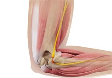 Ulnar Nerve Compression at the Elbow