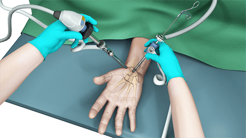 Wrist Arthroscopy