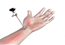 Wrist Arthroscopy