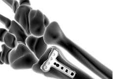 Wrist Fracture Fixation