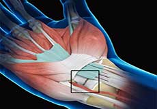 Wrist Ligament Reconstruction